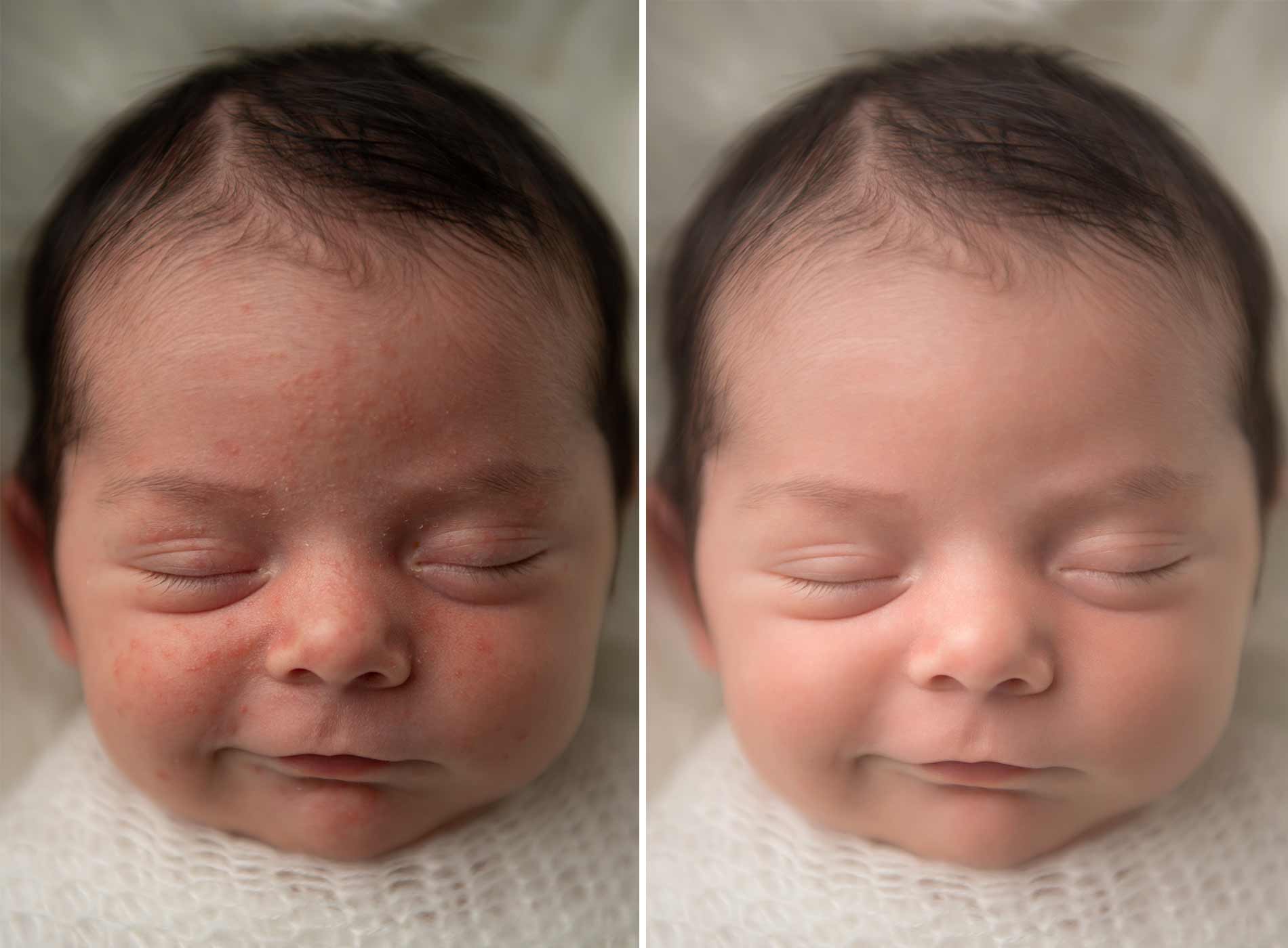 Skin editing on a newborn with baby acne
